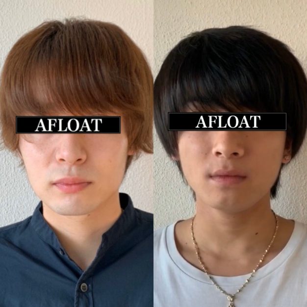男性のハチ張りのお悩みの解説